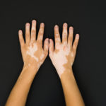 Vitiligo