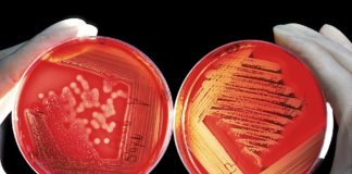 (C) Pixabay: Diptherie wird durch Bakterien verursacht. Weitere labordiagnostische Abklärungen wurden veranlasst.